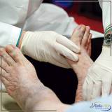 unha do pé infeccionada em diabéticos Lapa